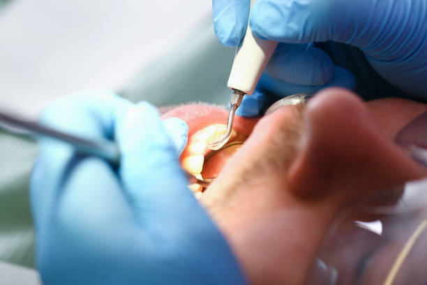 Best Emergency Dentist for Knocked-Out Tooth in USA